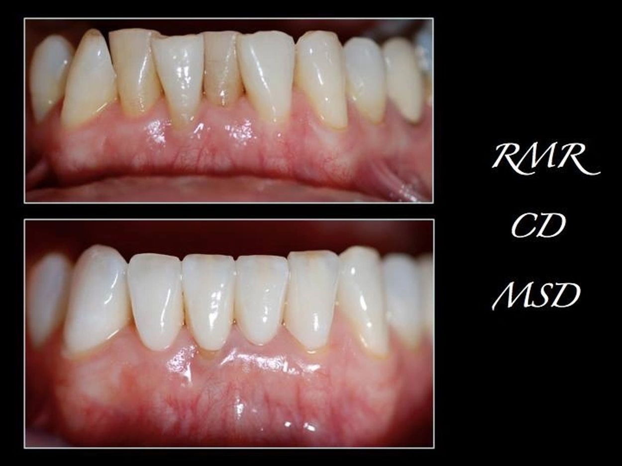 Feldspathic Veneers.