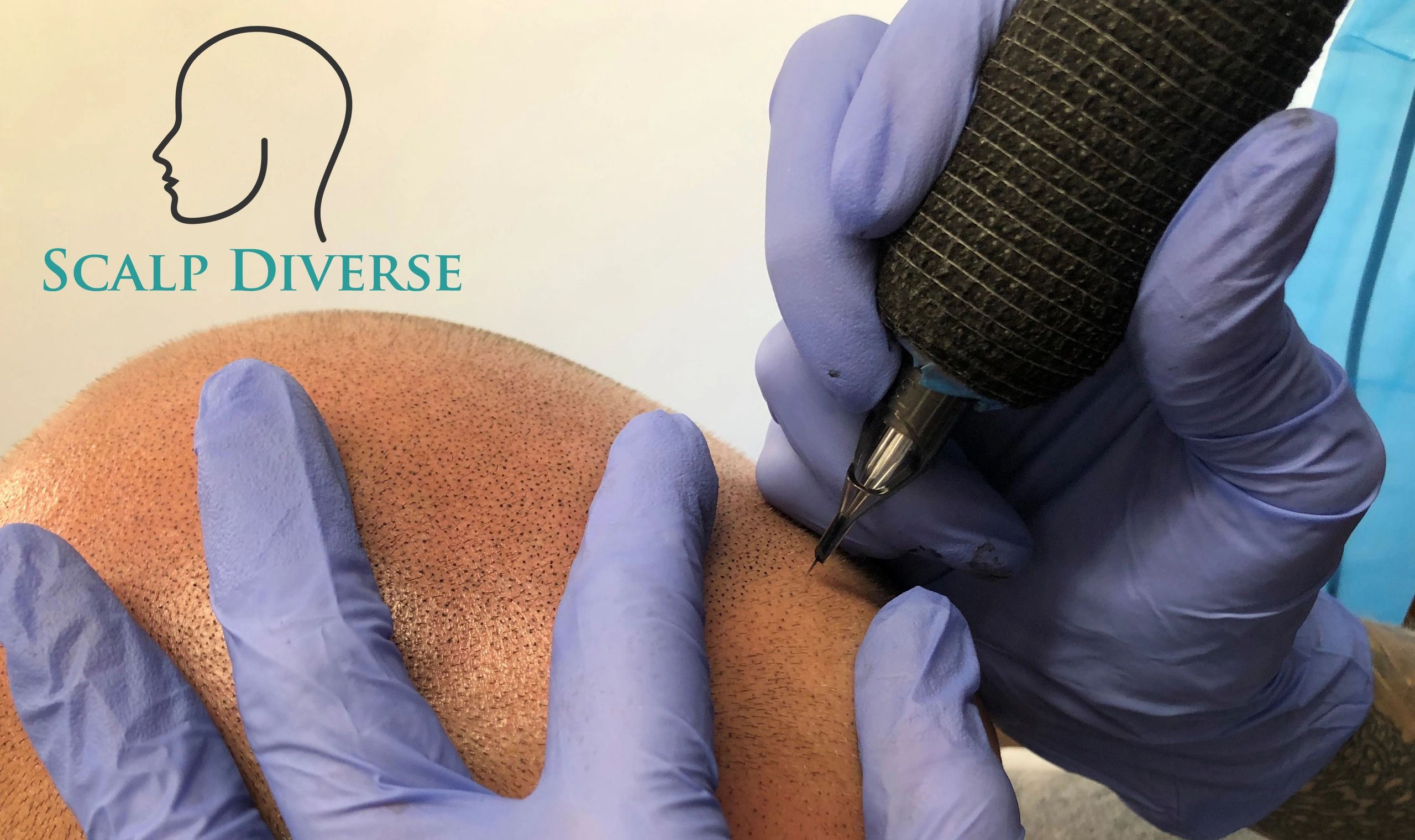 Scalp Diverse Scalp Micropigmentation, Hair Loss Treatment