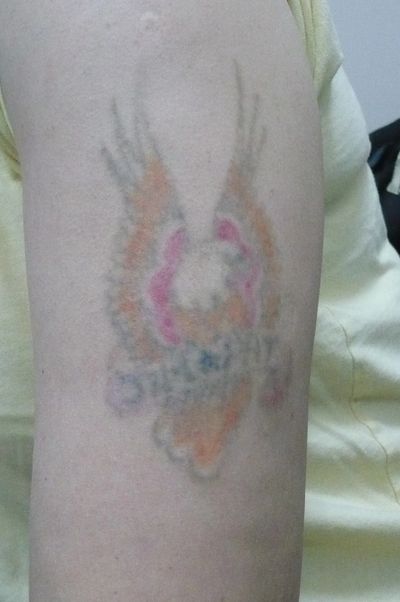 Tattoo Removal Photo
