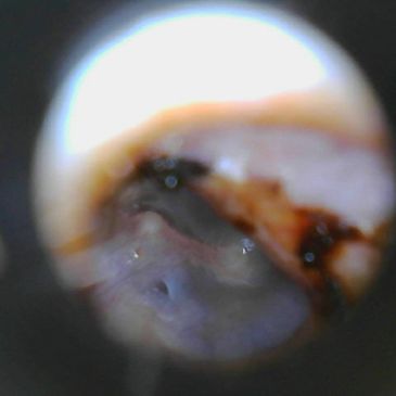 Clear ear canal and distant ear drum.