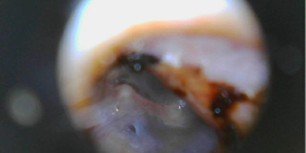 Clear ear canal and distant ear drum.