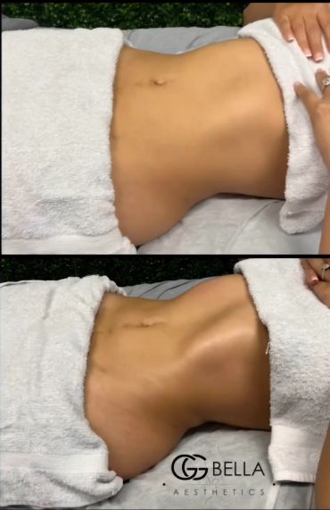 Before and after aesthetic abdominal treatment.