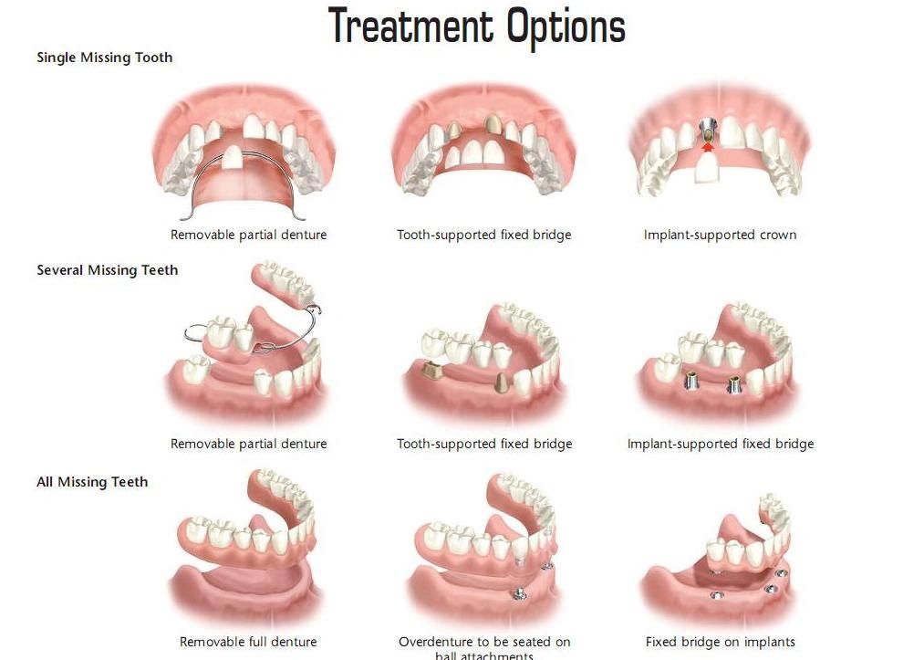 Какие зубные протезы лучше при отсутствии зубов. Классификация несъемных протезов ортопедическая стоматология. Виды съемных и несъемных протезов. Виды съемных протезов, применяемых при частичном отсутствии зубов..