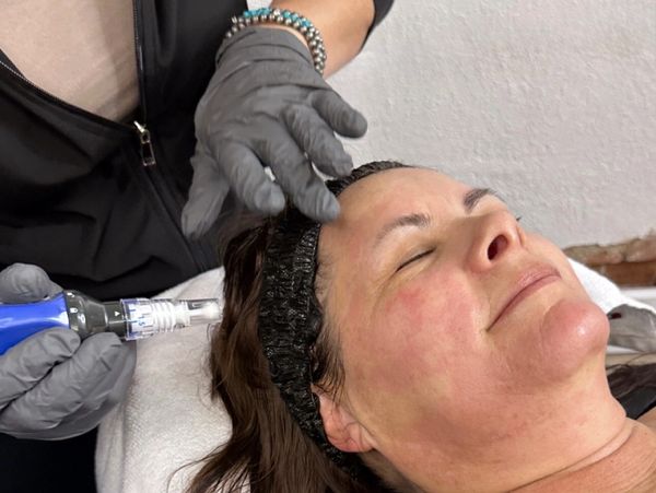 skinpen microneedling treatment as a good treatment to use with a membership at peak aesthetics ID