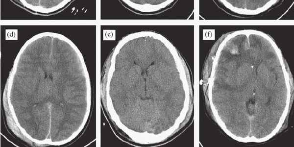 A Babak et al (2013). Intracranial pressure (ICP) level estimation using ...