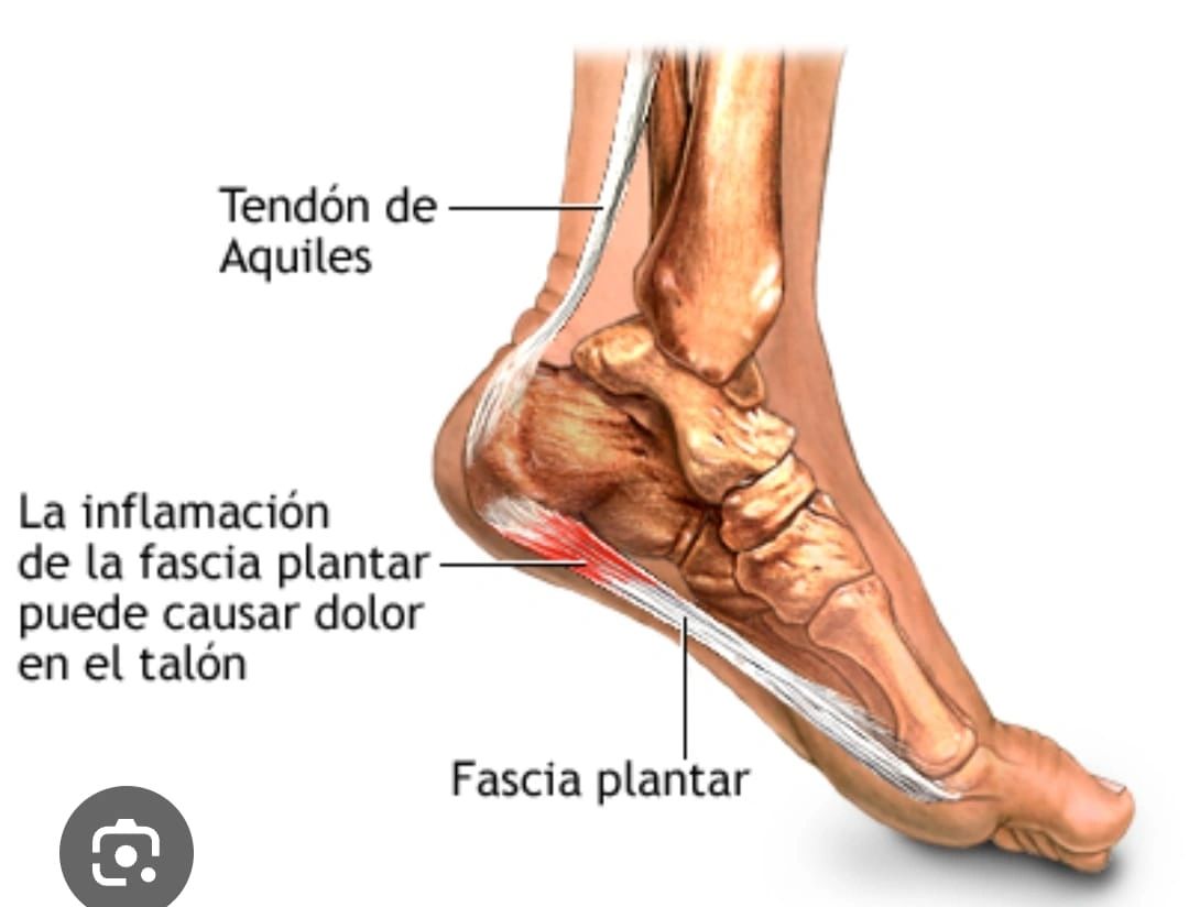 Plantar Fasciitis