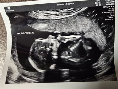 Ultrasound image of a fetus sucking its thumb.