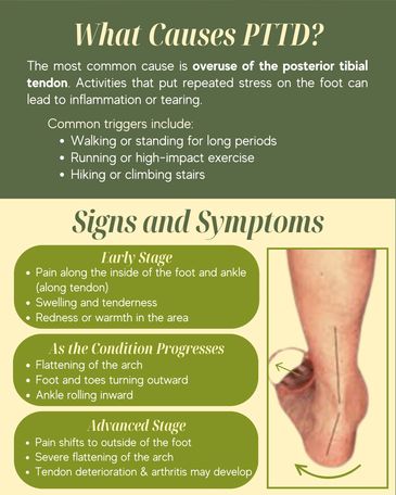 Infographic explaining causes, signs, and symptoms of Posterior Tibial Tendon Dysfunction (PTTD) with foot anatomy image.