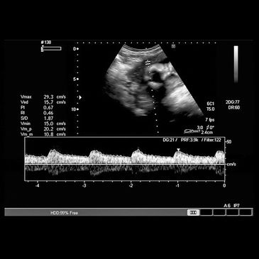 10-14 weeks Baby Heartbeat.