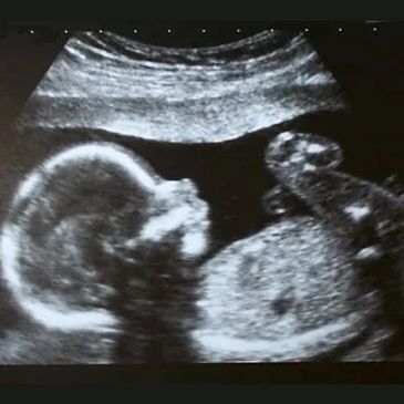 14-20 weeks ultrasound image