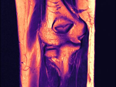 Elbow MRI anatomy