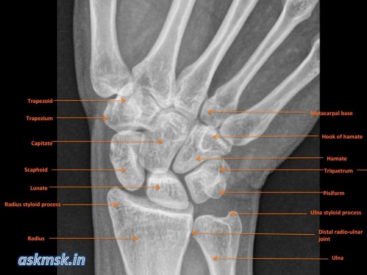 hand bones xray