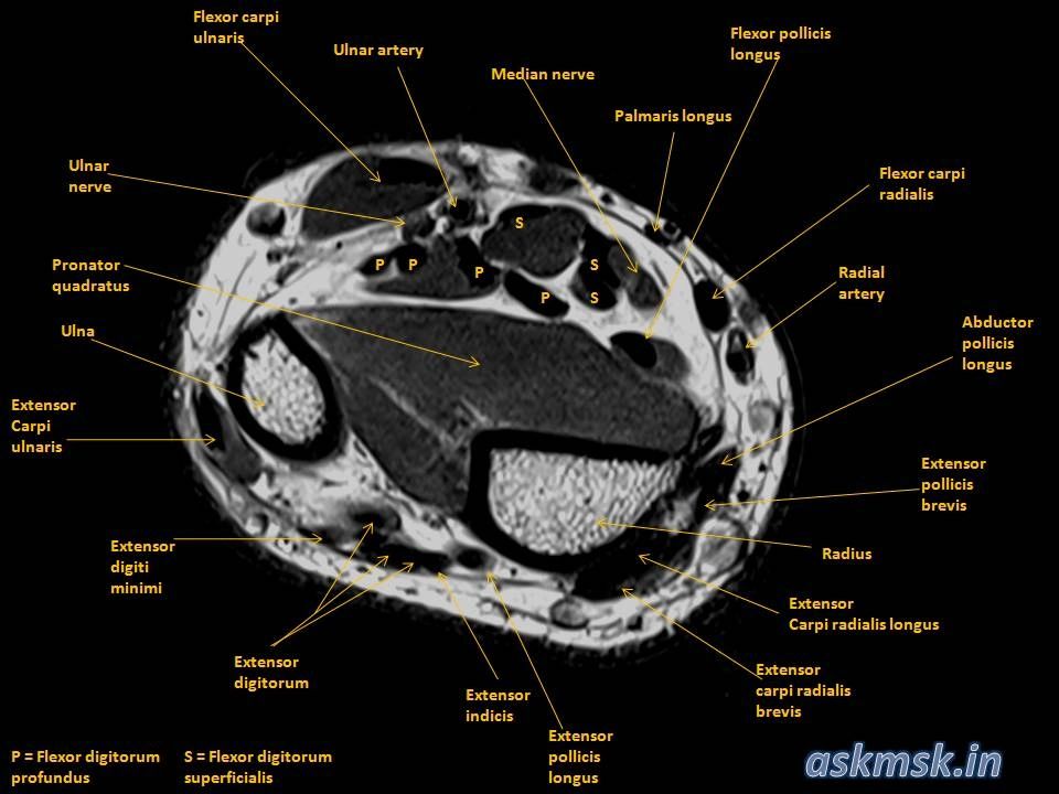 extensor pollicis longus mri