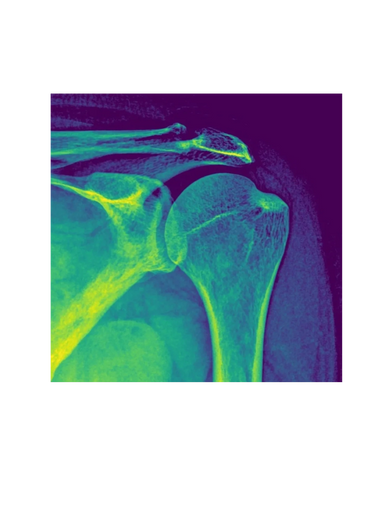 Shoulder Xray anatomy