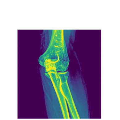 Elbow Xray anatomy