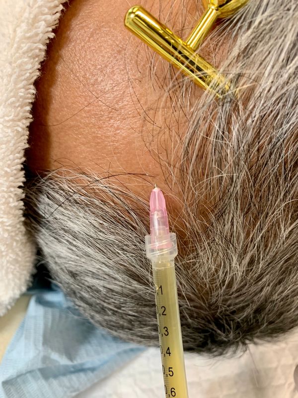 A man with thinning hair undergoing Platelet Rich Plasma (PRP) for hair loss treatment to grow hair