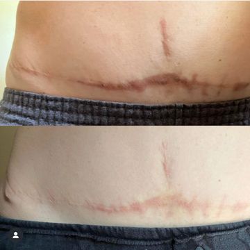 This is a tummy tuck scar that was lightened during 4 sessions of scar camouflage.