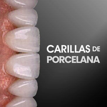 Close-up of porcelain dental veneers on teeth with text about porcelain veneers.