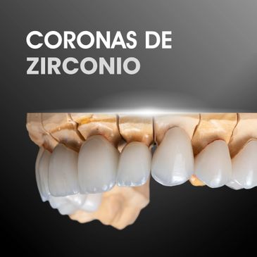 Close-up of zirconia dental crowns on a model jaw.