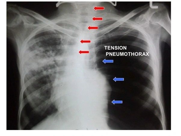 tension pneumothorax mediastinal shift