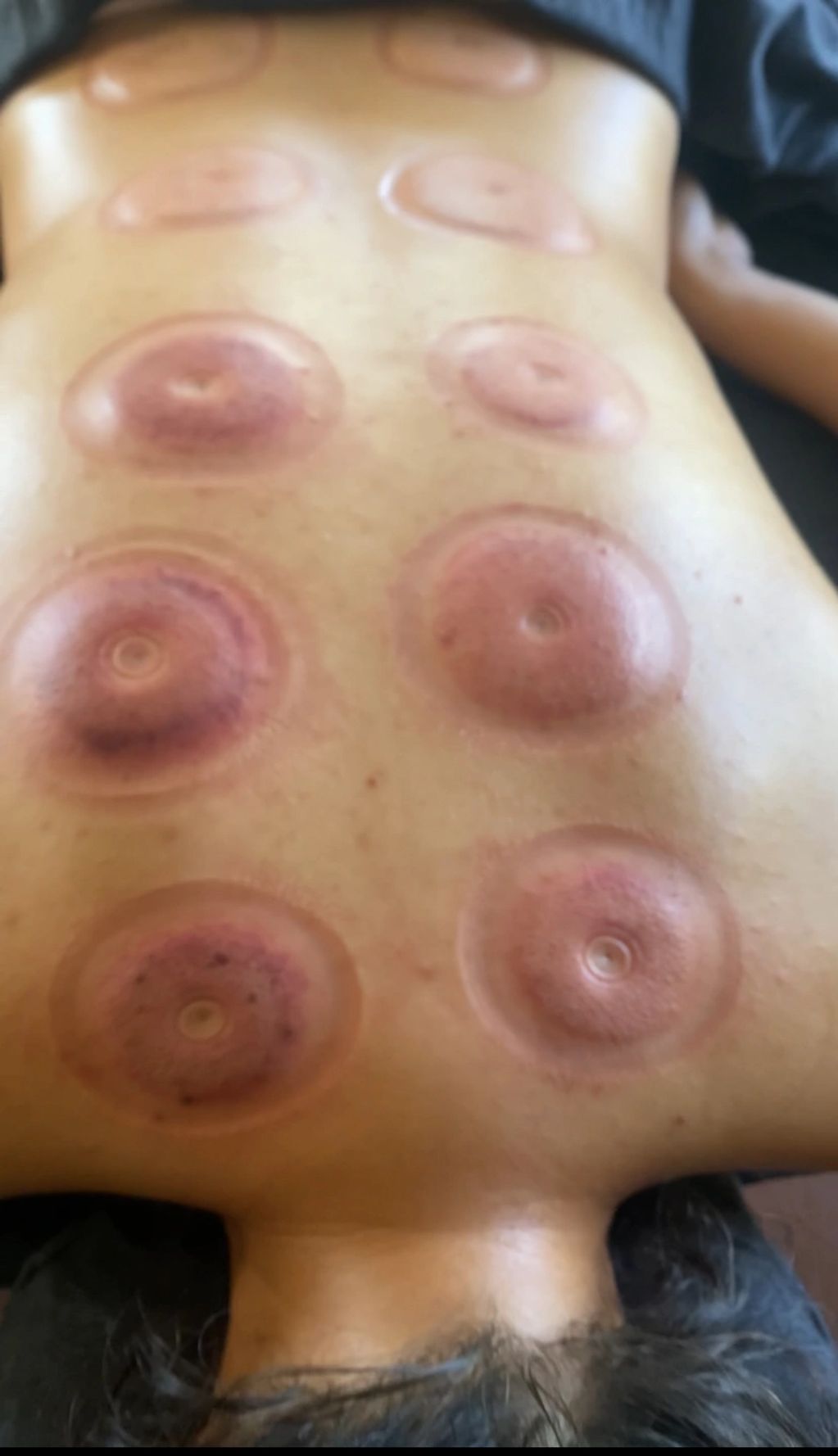 Cupping 