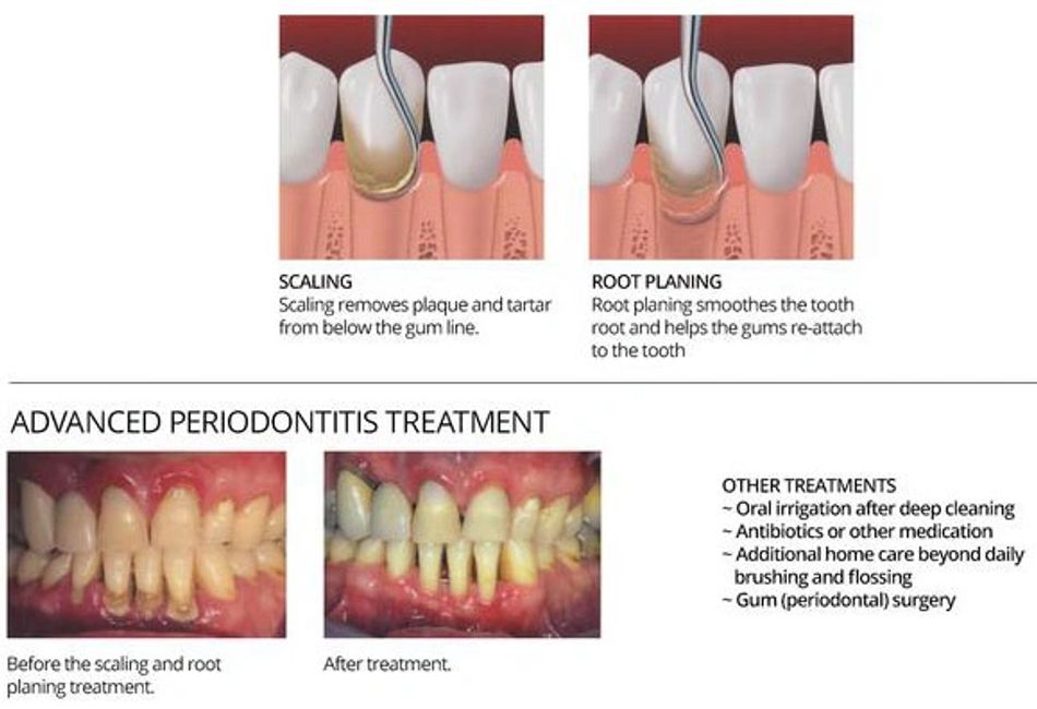 Teeth Cleaning Dr. Tracy G. Golden