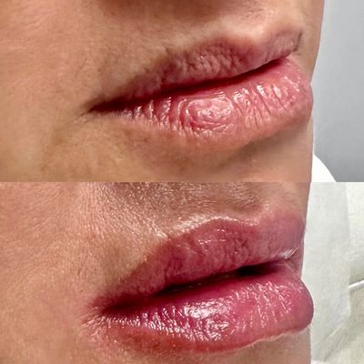 Close-up of lips before and after treatment showing improved hydration and texture.