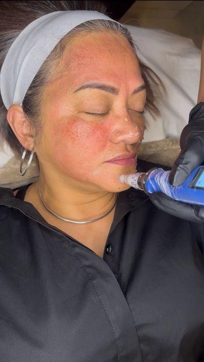 Woman receiving a facial treatment with a device.