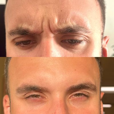 Before and after images showing reduction of forehead wrinkles.