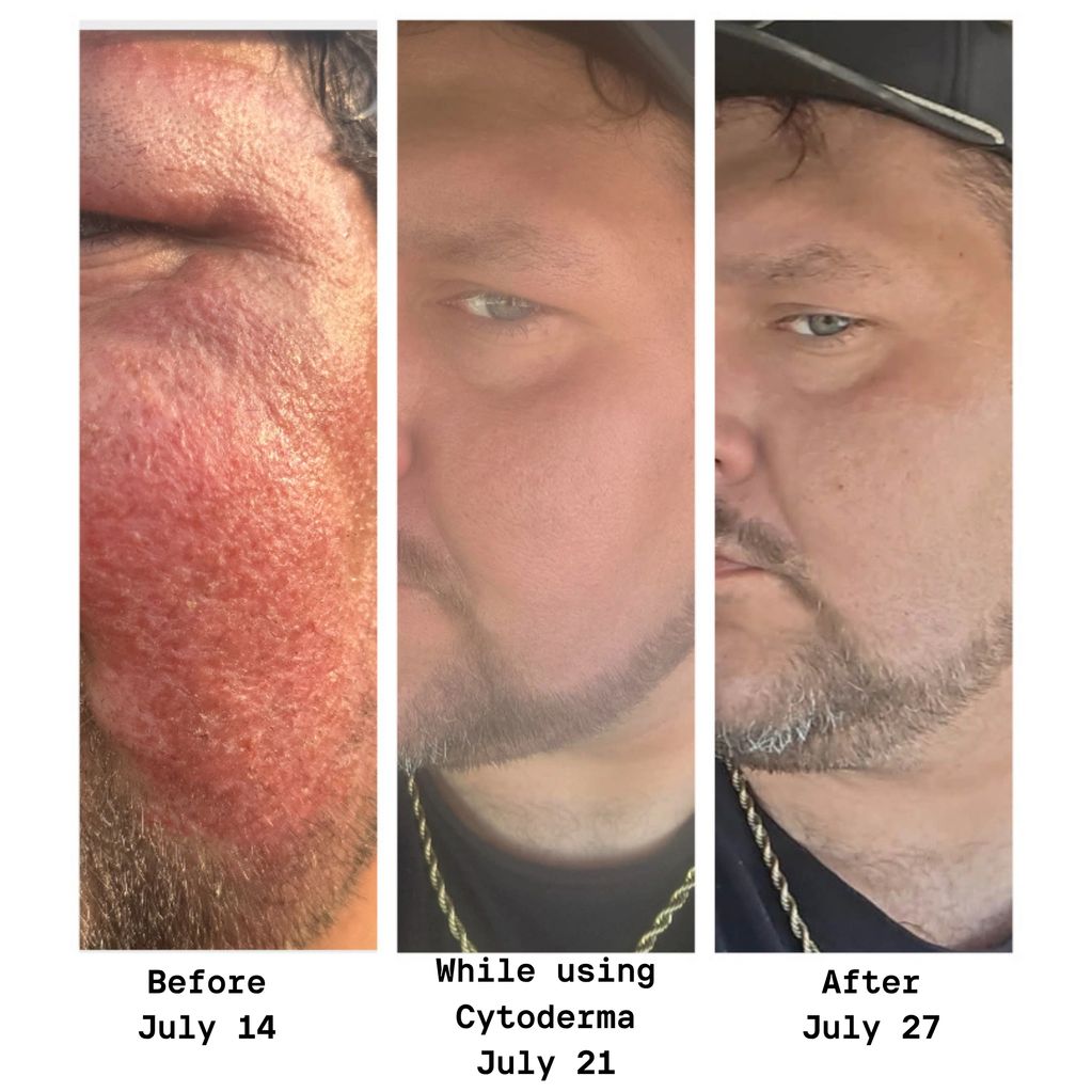 Skin improvement over two weeks using Cytoderma.
