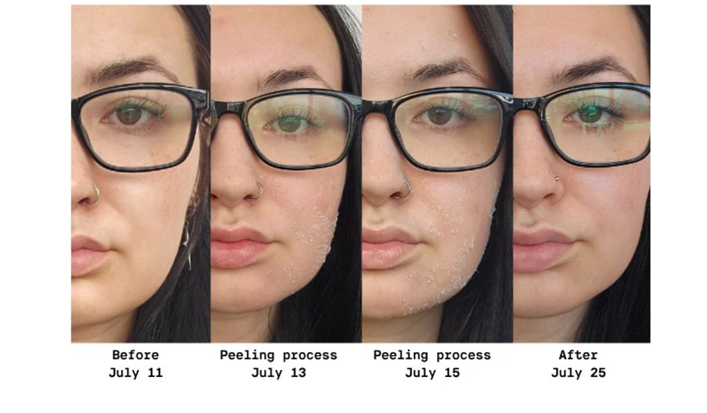 Face transformation during peeling process from July 11 to July 25.