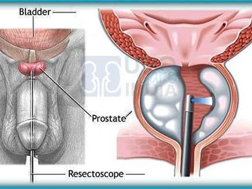 Prostate, BPH, BHP