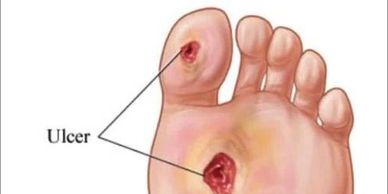 Diabetic foot, infection of food