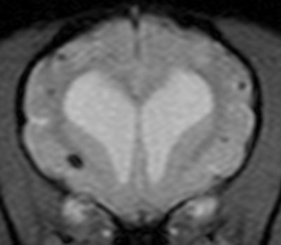 MRI scan showing a brain cross-section with visible ventricles.