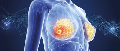 Mastectomy