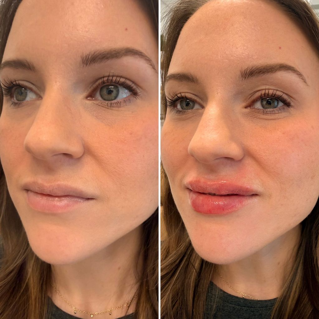Before and after lip enhancement showing fuller lips.