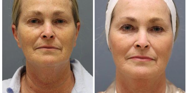 Microneedling before/after
