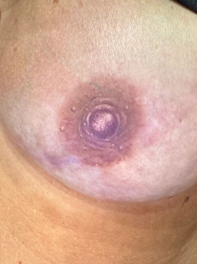 Example of a healed reconstructed areola tattoo on patient with reconstructed mastectomy