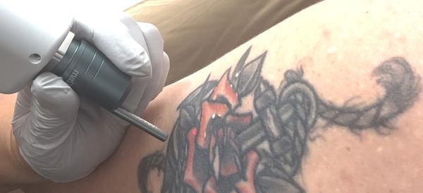 Laser Tattoo Removal 