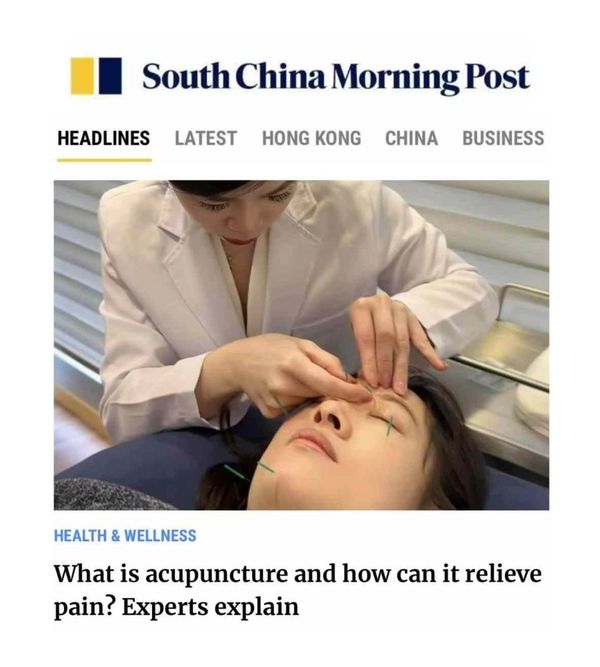 Acupuncture Benefits