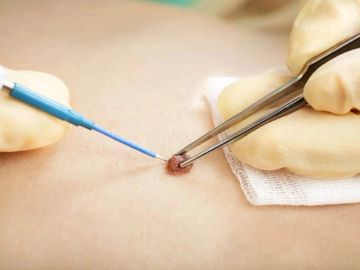 Dermatosurgery and Mole Removal