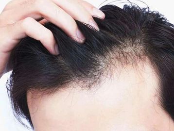 Hairfall and Hairloss Treatment