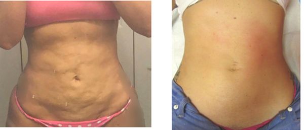 Post liposuction, BBL, or tummy tuck surgery Lymphatic massage