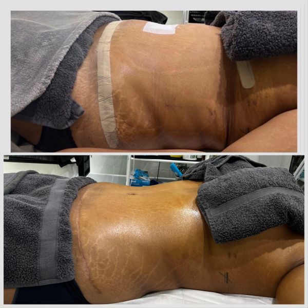 Before and after photos of a body treatment showing smoother skin and reduced marks.