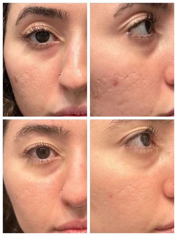 Before and after photos showing reduced acne scars and smoother skin texture.