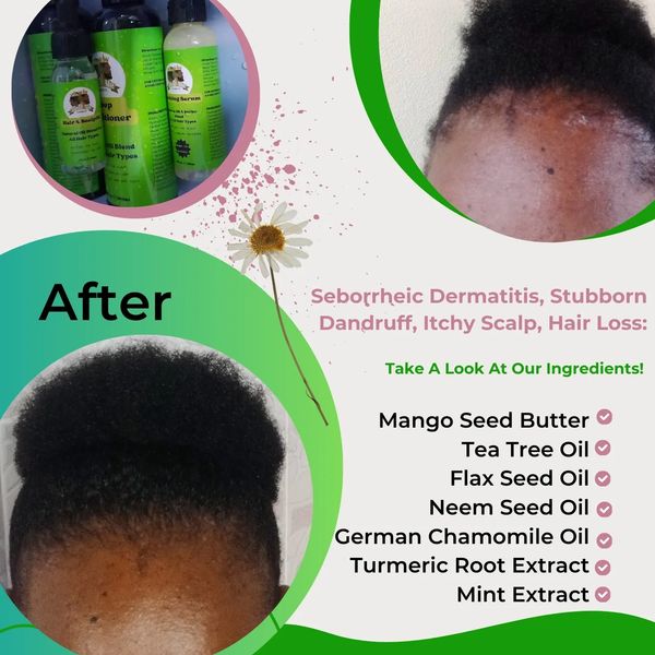 Before and after hair treatment for seborrheic dermatitis with natural oil products.