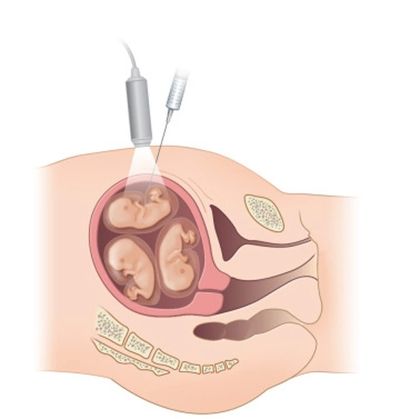 Multifetal pregnancy reduction(MFPR)