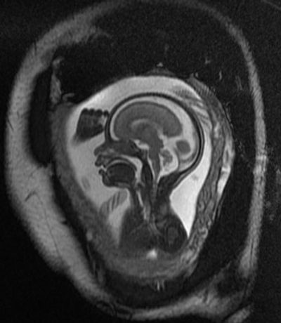 Fetal MRI picture