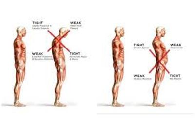 Lower Crossed Syndrome vs. Upper Crossed Syndrome