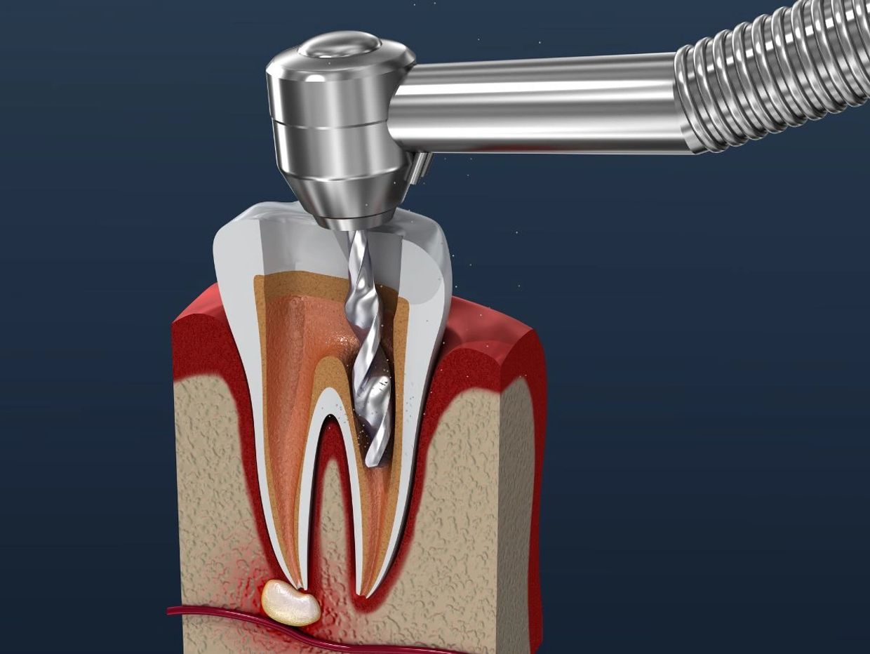 RCT - Root Canal